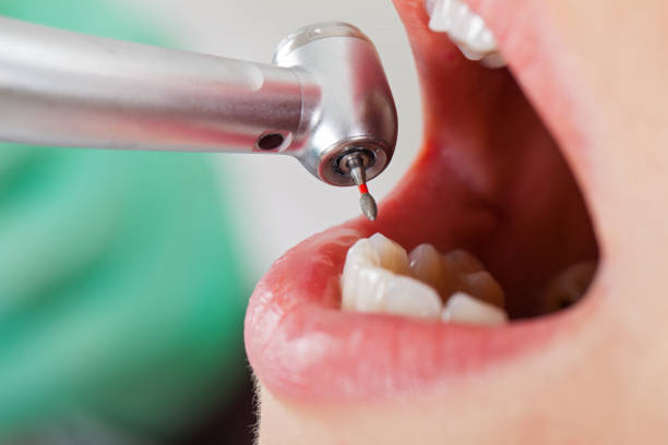 Best Emergency Dentist for Knocked-Out Tooth in Fellsburg, PA